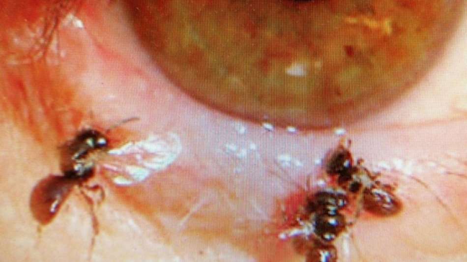 Arzt in Taiwan holt vier lebendige Bienen aus dem Auge einer Frau