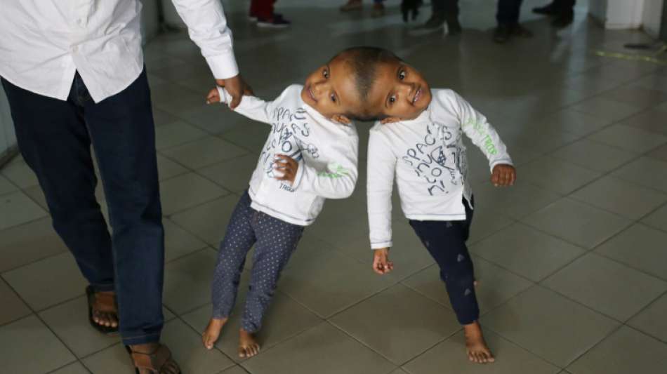 Ungarische Ärzte trennen siamesische Zwillinge aus Bangladesch