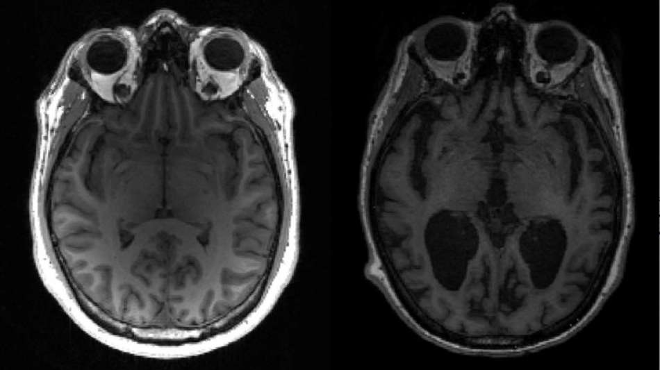 Wissenschaftler gewinnen neue Erkenntnisse zum Verlauf von Alzheimer