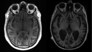 Wissenschaftler gewinnen neue Erkenntnisse zum Verlauf von Alzheimer