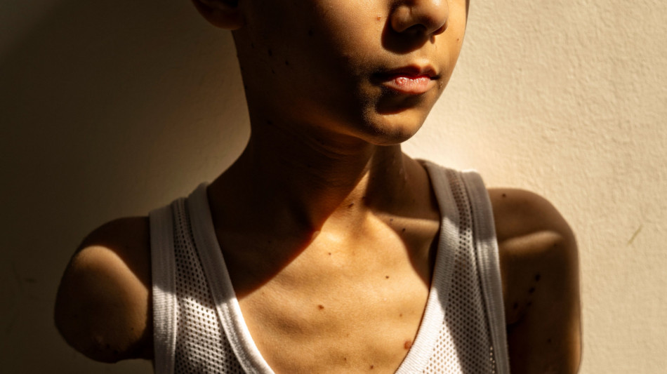 World Press Photo, il bambino amputato a Gaza è foto dell'anno